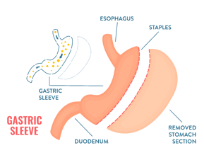 Gastric Sleeve graphic-1-1