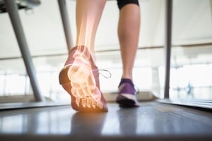 plantar fasciitis