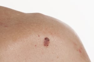 basal cell carcinoma-1