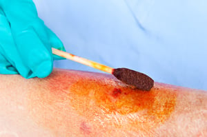 radiation wound care