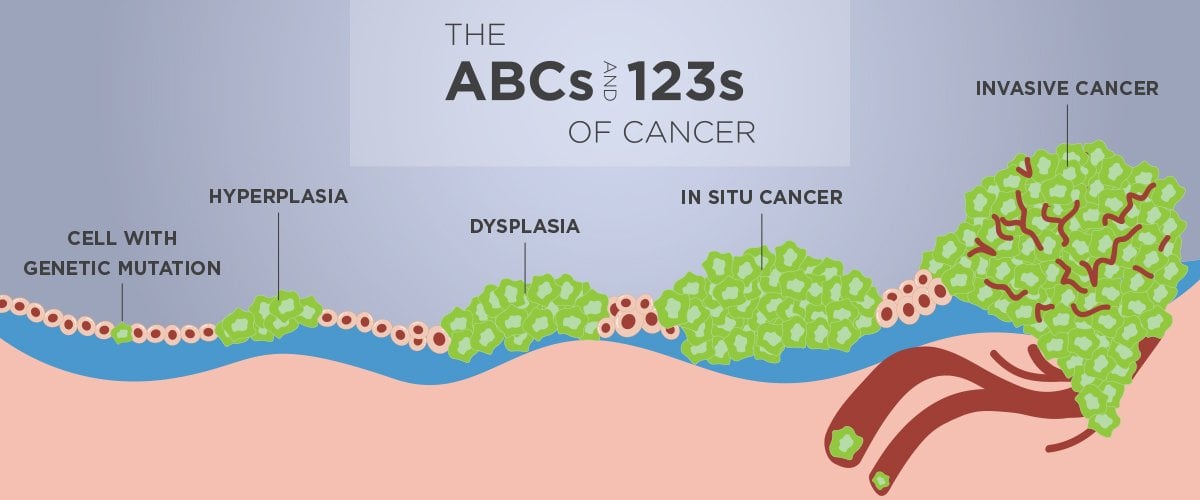 The ABCs and 123s of Cancer Stages