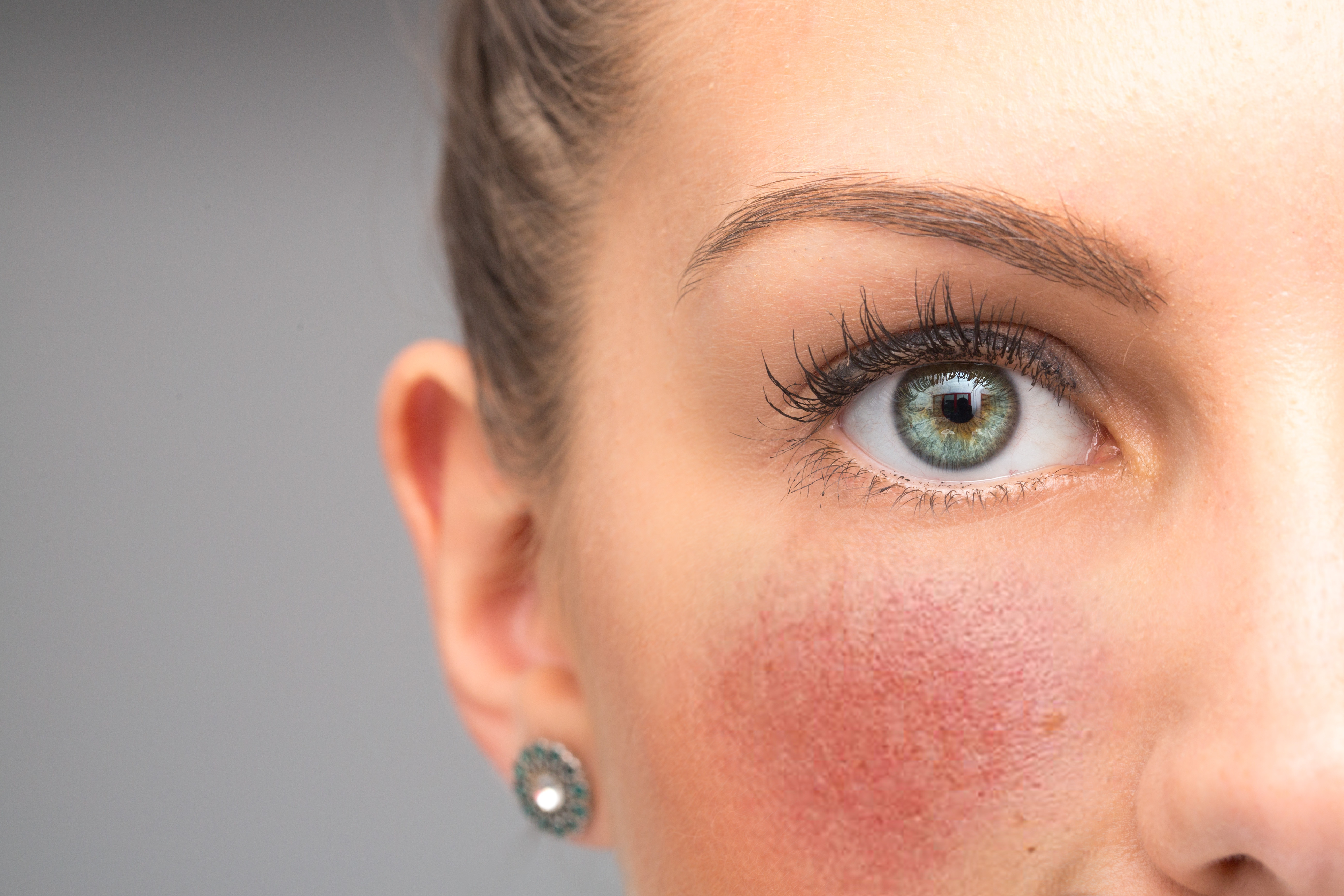 Treating Rosacea with the Help of a Dermatologist