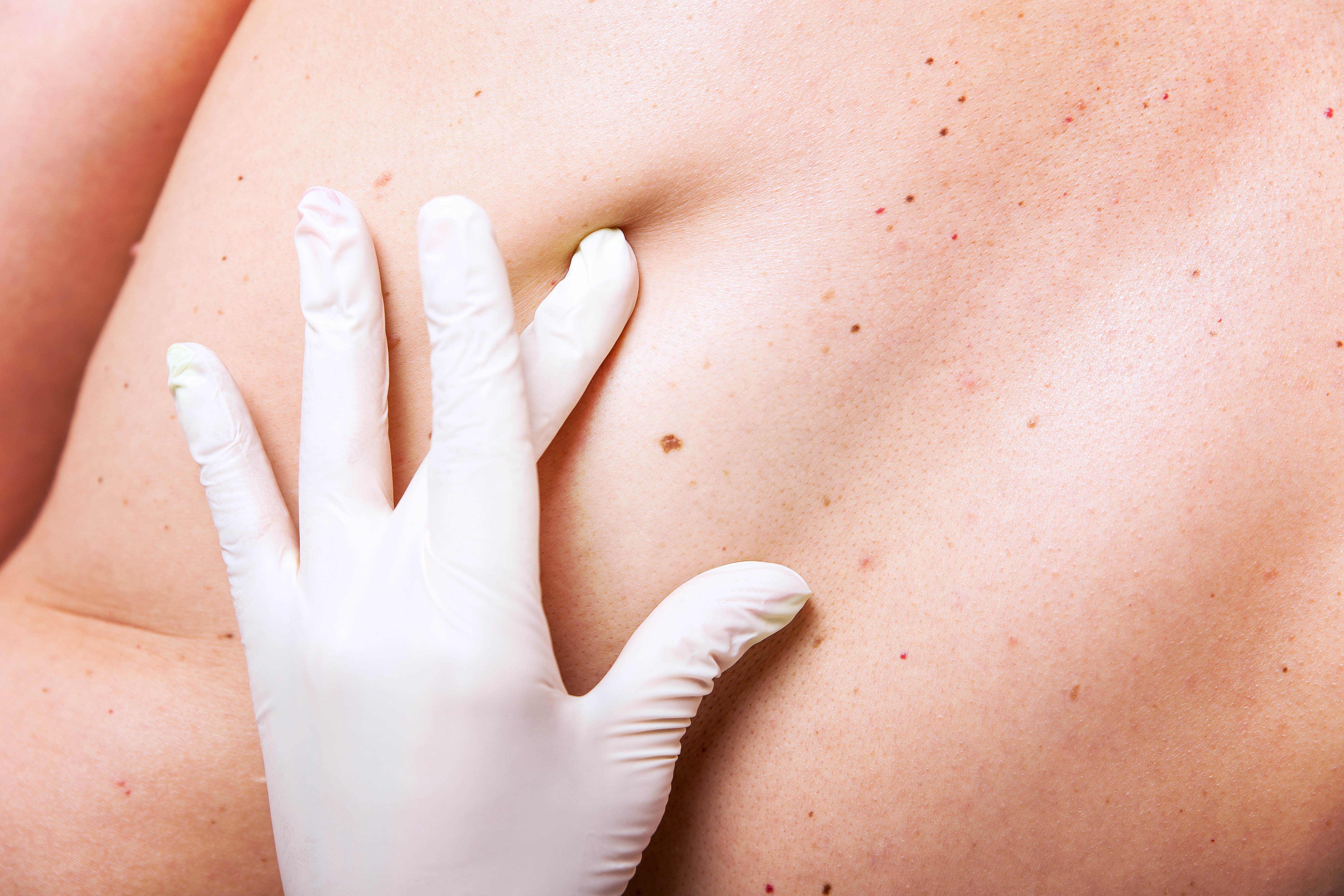 Advanced Dermatology to Host Skin Cancer Screening