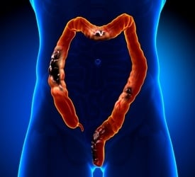 What to Know About Colorectal Cancer and How to Prevent It
