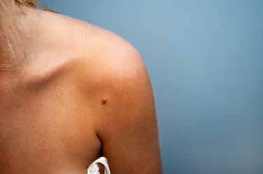 4 Steps you can Take Now to Prevent Skin Cancer