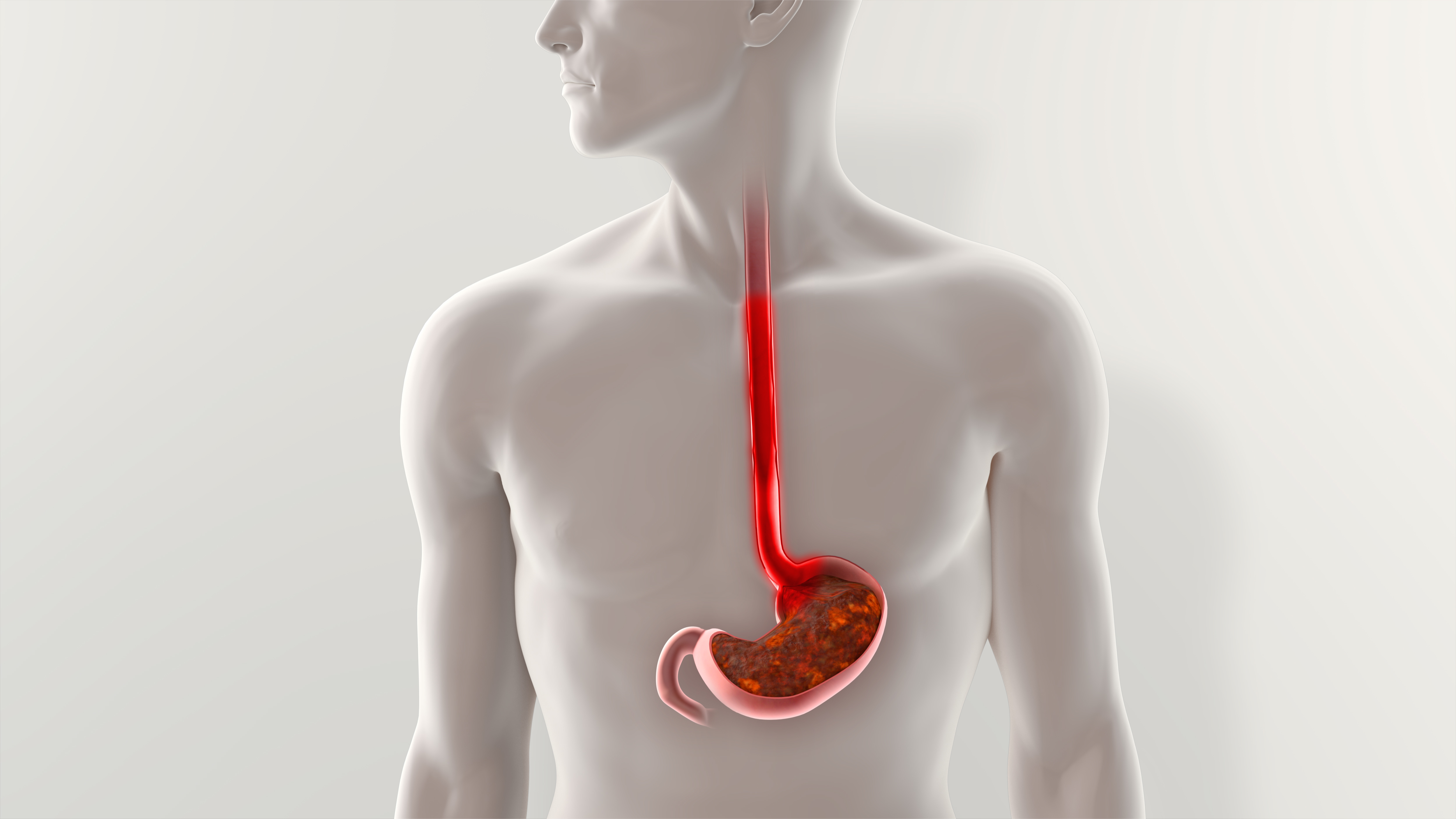 Getting to the Source of GERD with an Upper GI Endoscopy