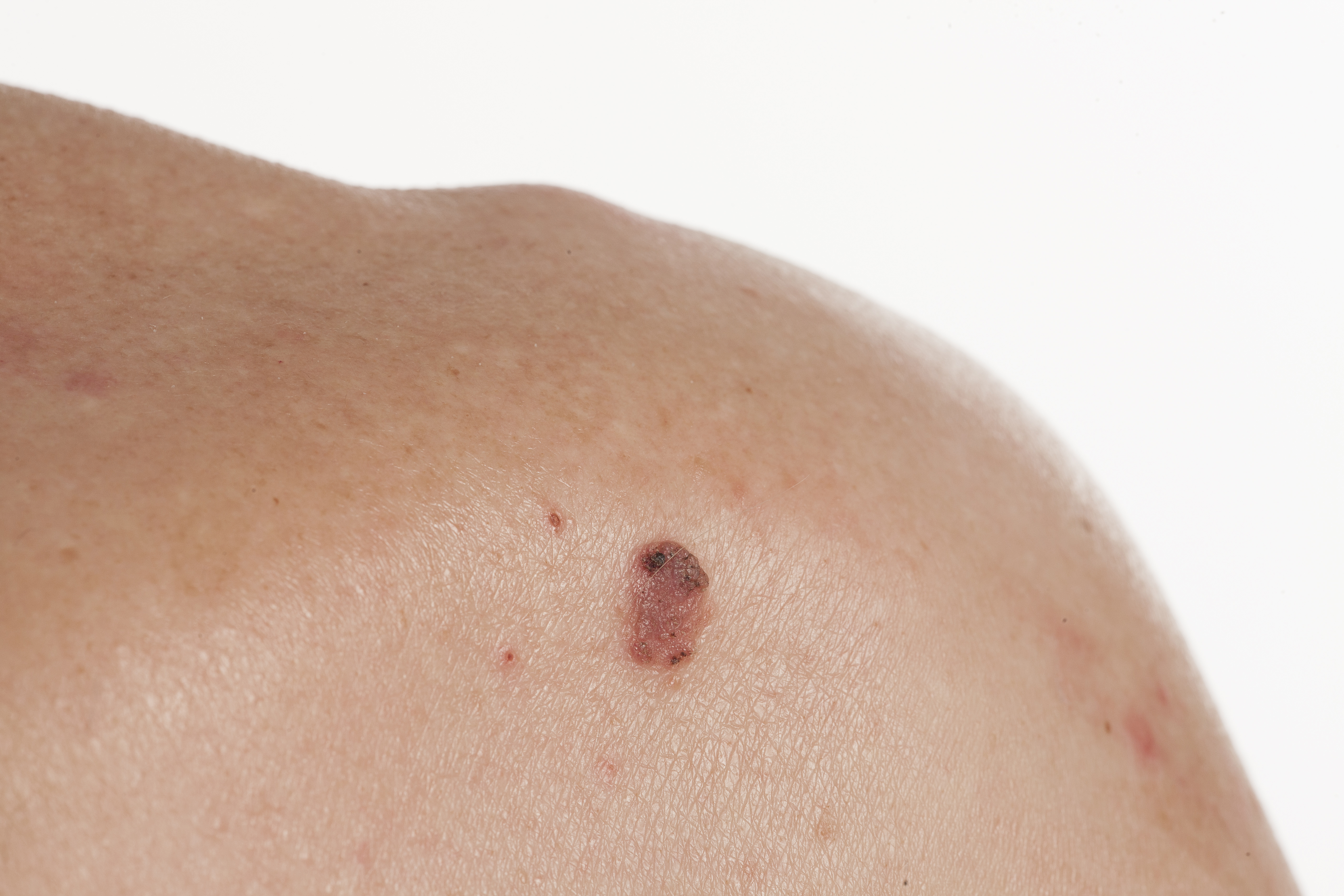 The 5 Step Process to Spotting Melanoma