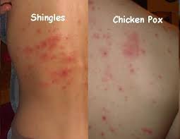 Chickenpox versus shingles—What’s the difference?