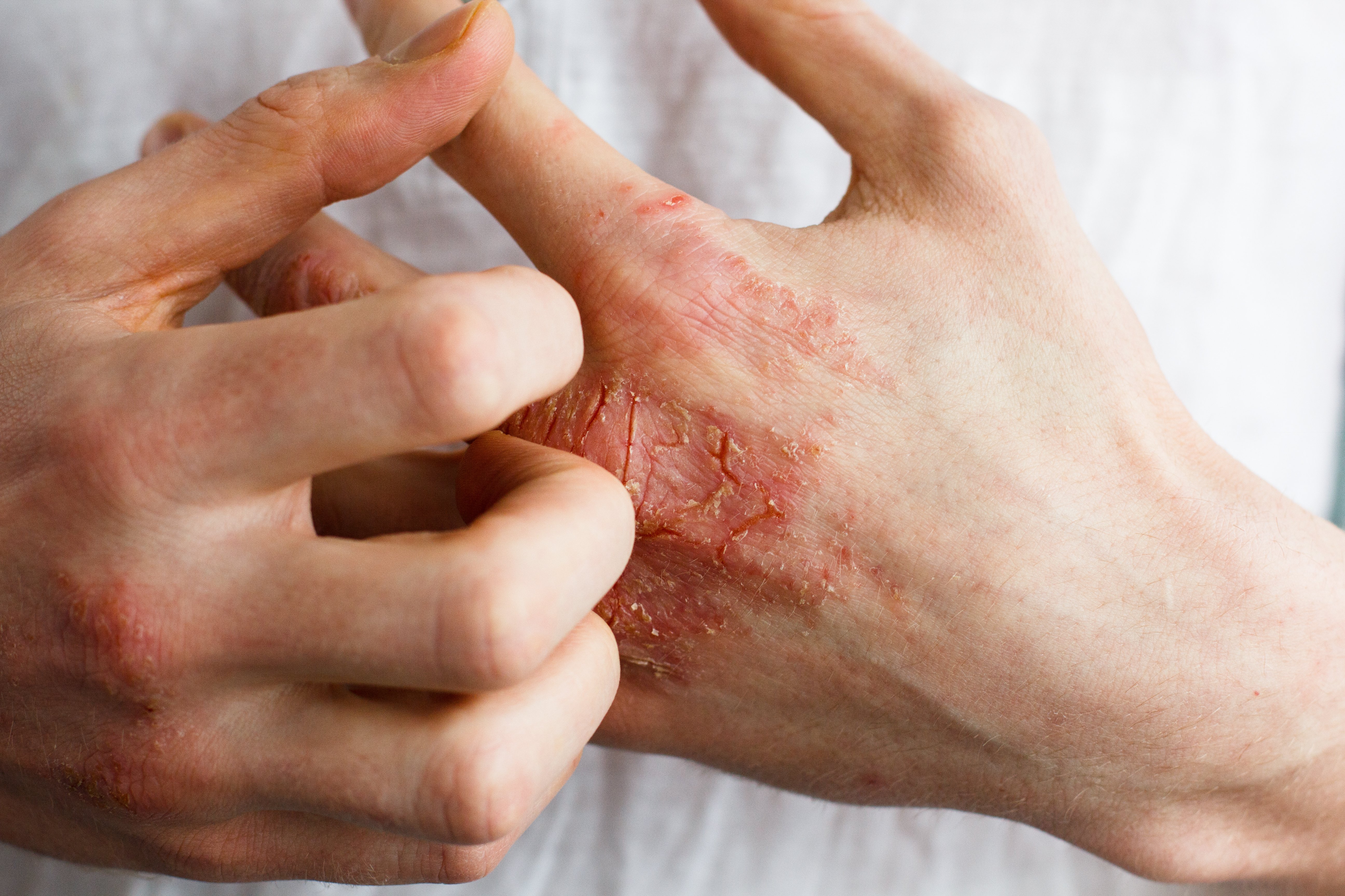 Effectively Treating Eczema