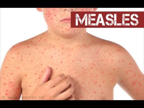 Infection Prevention and You: What is Measles?