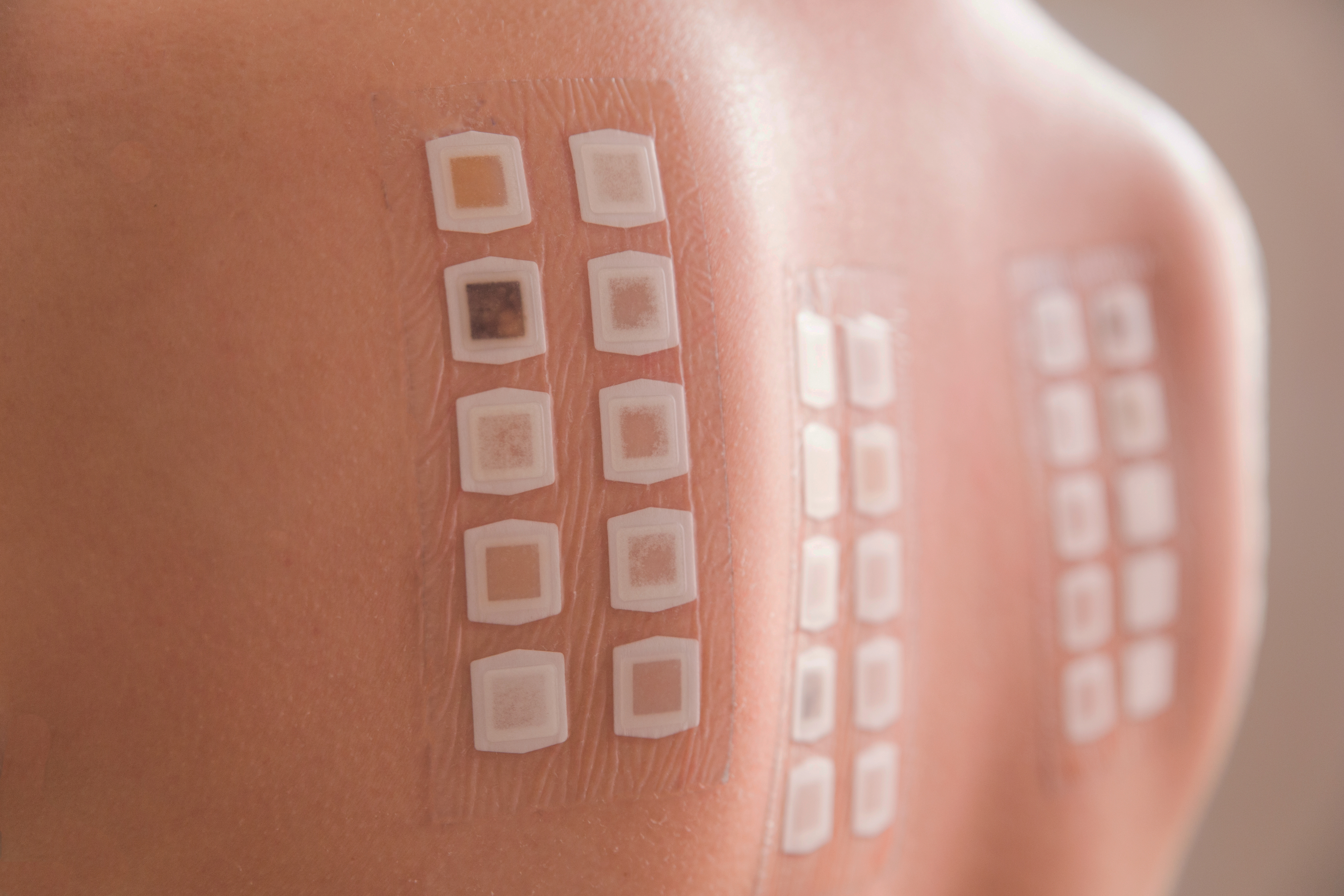 Is Patch Allergy Testing Right for You?