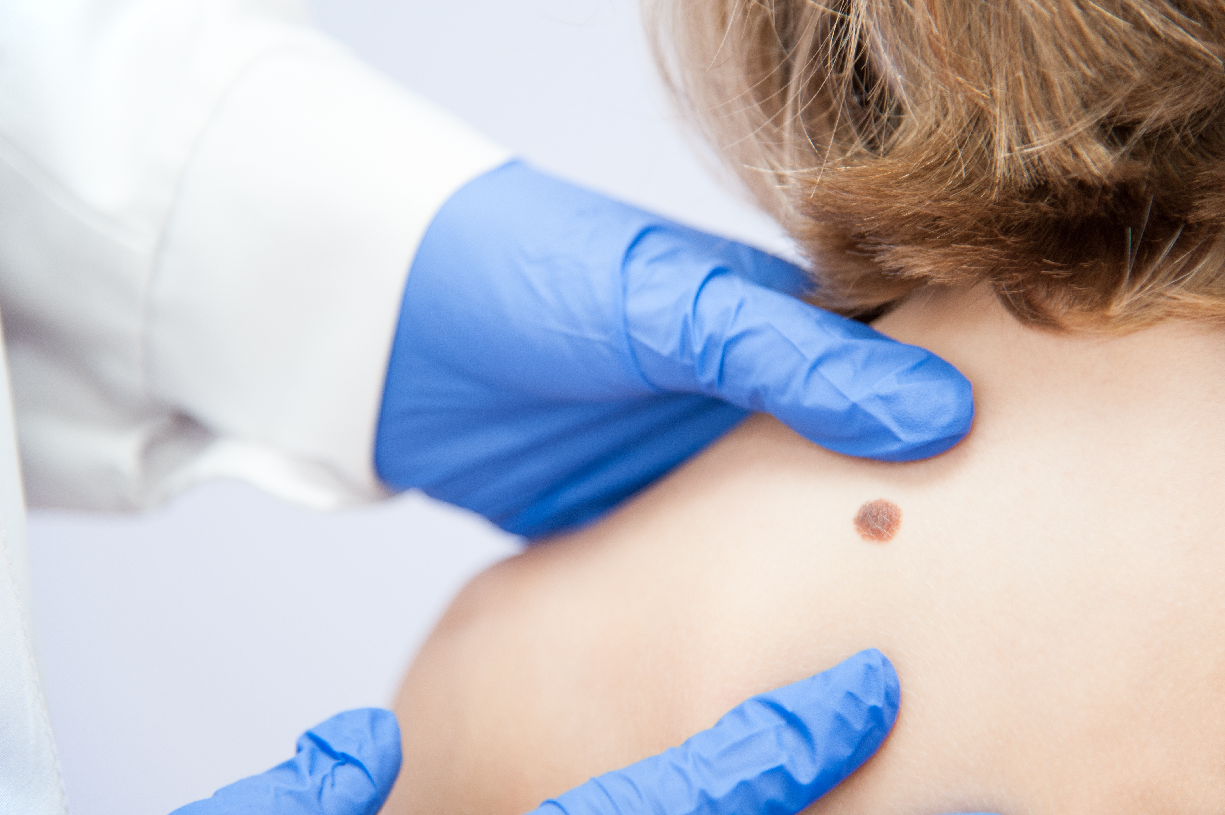 Squamous Cell vs. Basal Cell Carcinoma